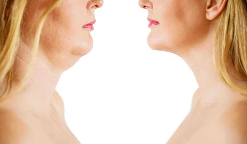 Double Chin treatment Wilmslow before and after results