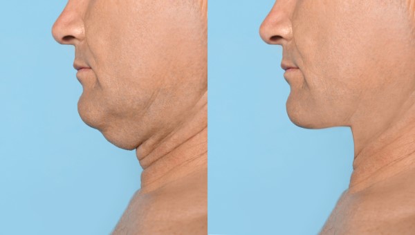 Which Non-Surgical Treatments Work Best for Jowls and Loose Skin Wilmslow?