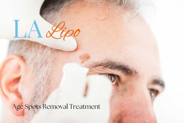 What Are the Most Effective Treatments for Age Spots Wilmslow?