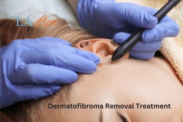 Dermatofibroma Removal Treatment Wilmslow