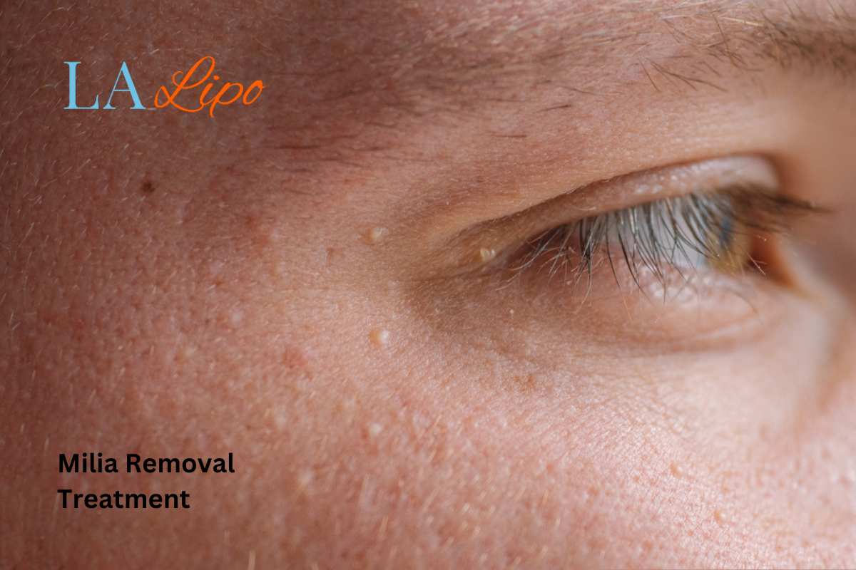 Cryopen Milia Removal: Is It the Easiest and Safest Option Wilmslow?