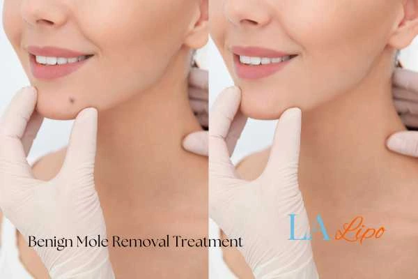 Before-and-after results following benign mole-removal treatment Wilmslow