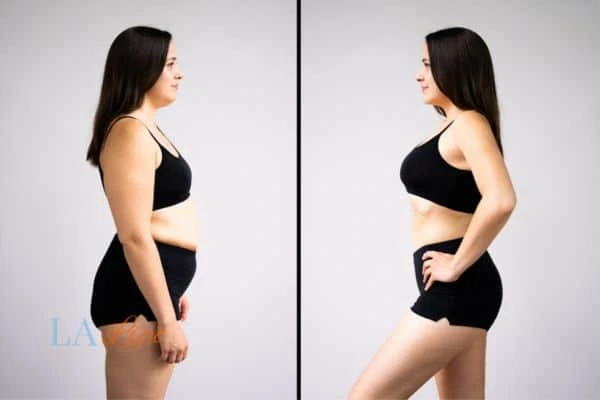 image of woman before and after results of LA-EMS Body Sculpting Wilmslow to help treat Diastasis recti