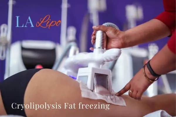 women getting fat freezing Wilmslow
