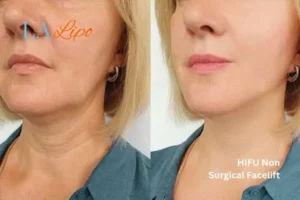 hi-fu for wrinkles Wilmslow before and after results