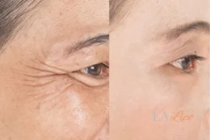 Before and after results of woman - HI-fu wrinkles reduction treatment Wilmslow
