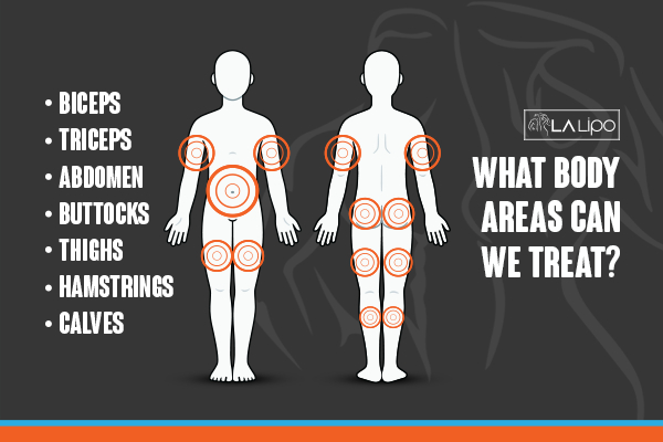 Graphic to show areas you can have LA-EMS Body Sculpting Wilmslow treatment.
