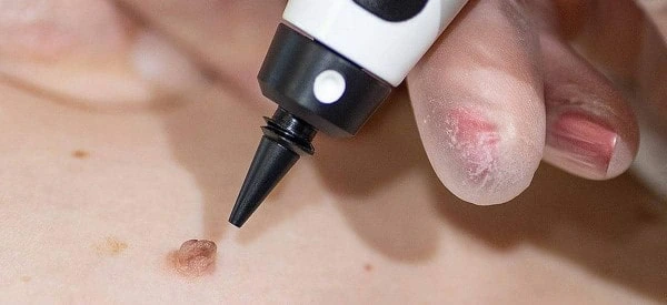 skin tag removal using cryopen Wilmslow