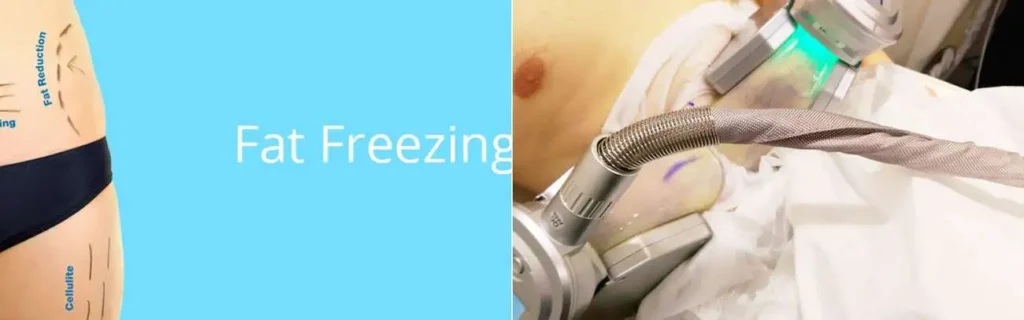Fat freezing Wilmslow on multiple areas of the body