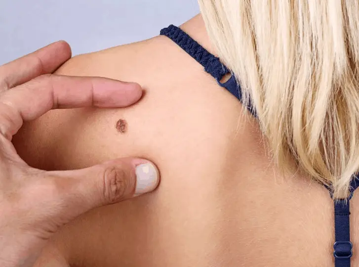 woman having mole removal Wilmslow consultation before treatment.