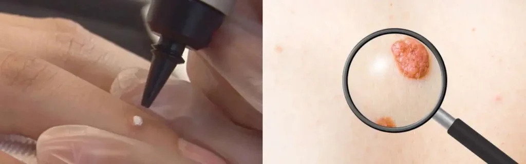 Cryopen for mole removal Wilmslow - speak to our team today!