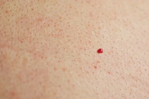 close up of a cherry angioma Wilmslow