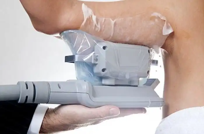 Picture of fat freezing Wilmslow on the upper arms.