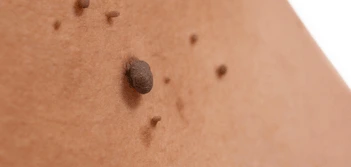 image of a skin tag Wilmslow