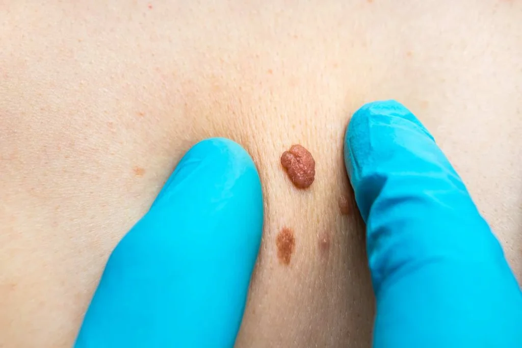 Consultant examining a skin tag Wilmslow