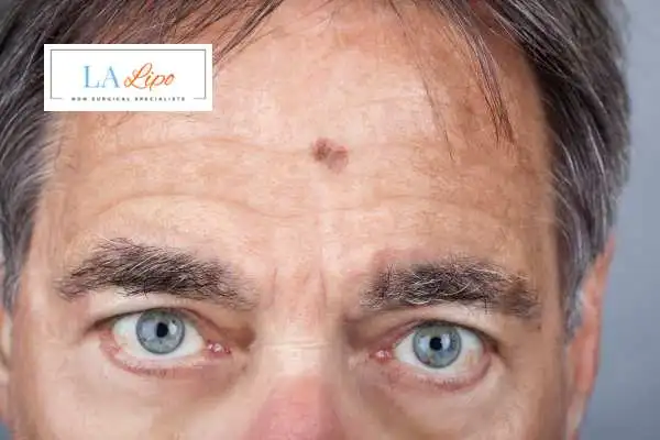Solar Lentigo Removal Wilmslow image of man with mark on his forehead