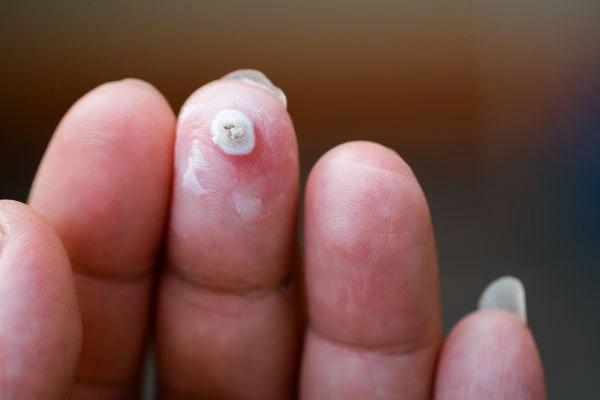 wart on person finger - cryotherapy to treat from LA LIPO Wilmslow