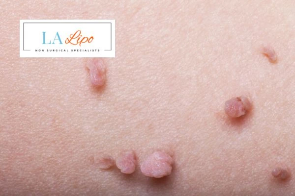 Does cryopen skin tag removal Wilmslow hurt? Find out now call our team today!