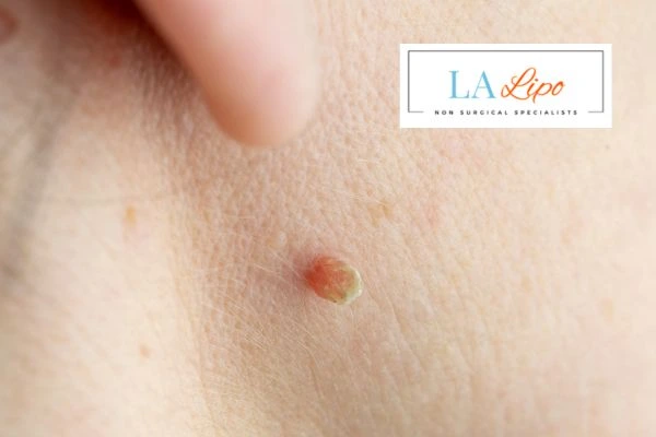 Book skin tag removal Wilmslow today speak to our team now!