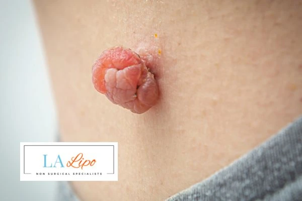 Interested in skin tag removal Wilmslow? Concerned about the pain? Find out more today!