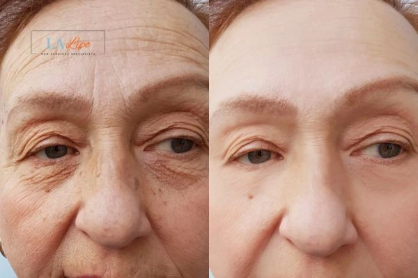 The powerful benefits of Morpheus8 Treatment Wilmslow - Call Our team today!
