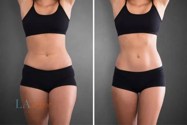 before and after results of non-surgical treatment to help a woman's body image and mental health Wilmslow