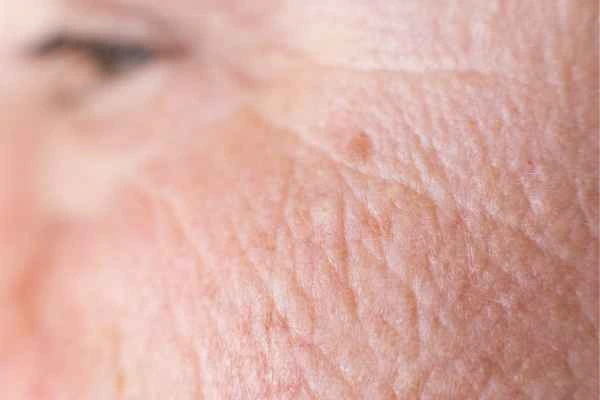 close up picture of a woman's face showing an age spot Wilmslow