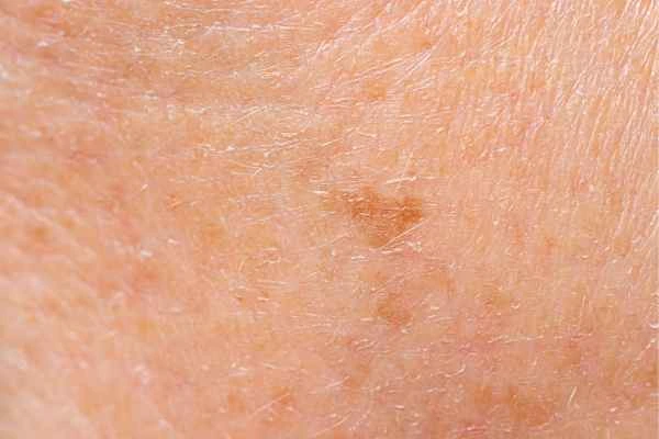 close up picture of age spots Wilmslow