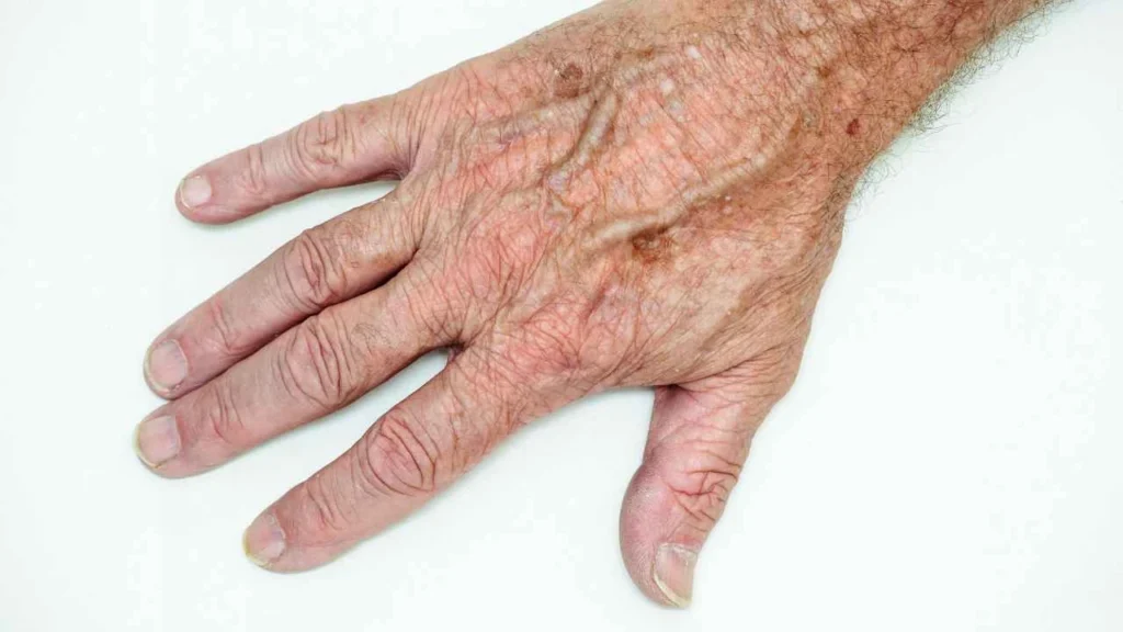 Male hand showing age spot Wilmslow