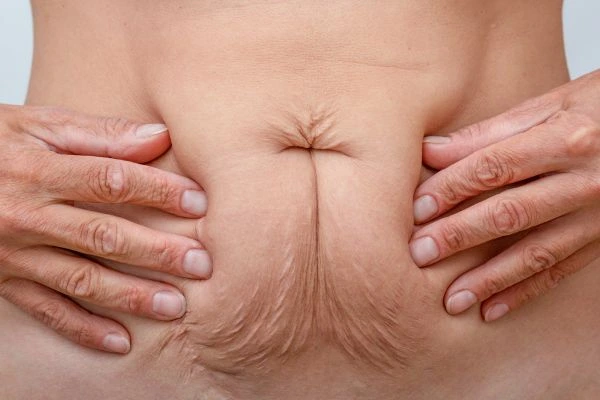 Image of a woman's stomach with loose skin - example of skin tightening Wilmslow options