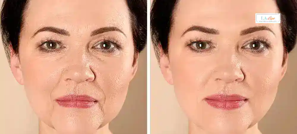 How Long Does It Take to See Results and How Long Do They Last Wilmslow?
