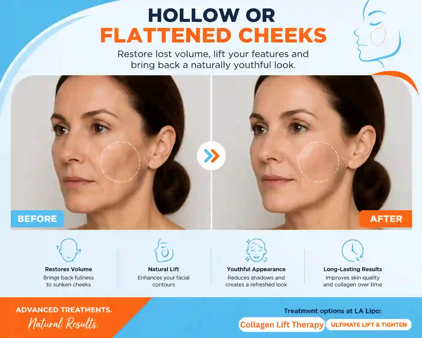 Sign #4: Hollow or Flattened Cheeks Wilmslow