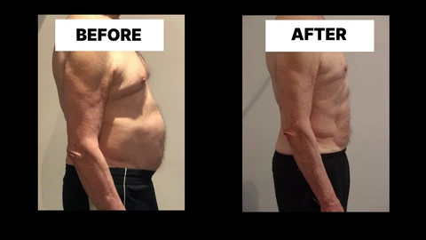 What Symptoms Can Diastasis Recti Cause in Men? Weak Core, Back Pain and Poor Posture Wilmslow